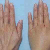 Cấy Mỡ Mu Bàn Tay – Bí Quyết Trẻ Hóa Đôi Bàn Tay Búp Măng Chuẩn Y Khoa Tại TMV Tiến Sĩ Trí