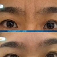 PHẪU THUẬT CẮT CƠ CAU MÀY: XÓA SỔ NẾP NHĂN SỐ 11, TRẢ LẠI THẦN THÁI NHẸ NHÀNG
