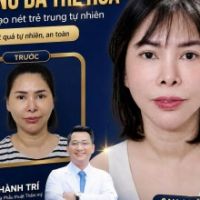Hiệu Quả Căng Da Mặt Bán Phần Và Toàn Phần SMAS – Lấy Lại 10-15 Tuổi Xuân Tại TMV Tiến Sĩ Trí