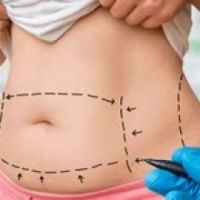 HÚT MỠ TẠO HÌNH THÀNH BỤNG BÁN PHẦN HAY TOÀN PHẦN: GIẢI PHÁP NÀO PHÙ HỢP NHẤT CHO BẠN?