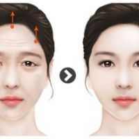 PHẪU THUẬT CĂNG DA TRÁN: XÓA NẾP NHĂN, NÂNG CUNG MÀY, ĐỔI MỚI DIỆN MẠO