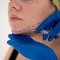 Căng Da Mặt Là Phương Pháp Trẻ Hóa Thần Kỳ – Giải Pháp Lưu Giữ Thanh Xuân