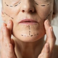 Phẫu thuật căng da mặt V-Line – Giải pháp trẻ hóa không sẹo, thon gọn tự nhiên