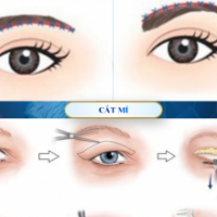 NÊN NÂNG CUNG MÀY HAY CẮT MÍ MẮT? LỜI KHUYÊN TỪ TS.BS ĐỖ THÀNH TRÍ