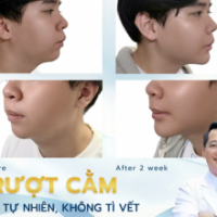 Trượt Cằm Nam Giới: Kiến Tạo Góc Nghiêng Nam Tính, Đĩnh Đạc | TS.BS Đỗ Thành Trí