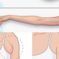  COMBO HÚT MỠ BẮP TAY, LƯNG VÀ NÁCH: BÍ QUYẾT XÓA BỎ 