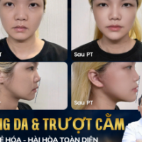 Căng Da Mặt Kết Hợp Trượt Cằm Cùng TS.BS Đỗ Thành Trí: Bộ Đôi Hoàn Hảo Xóa Da Chùng Nhão, Kiến Tạo G