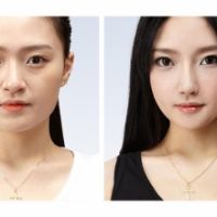 Hạ gò má và một số lưu ý bạn cần biết