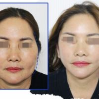 Làm Sao Để Trẻ Lại? – Giải Pháp Căng Da V-Line Giúp Bạn Quay Ngược Dấu Vết Thời Gian