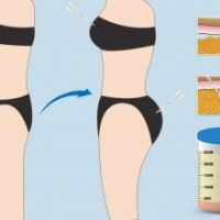 HÚT MỠ CẤY VÀO MÔNG: GIẢI PHÁP 