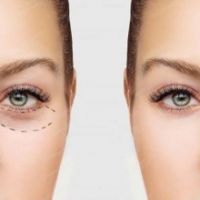 CẤY MỠ TRŨNG MẮT: GIẢI PHÁP LÀM ĐẦY RÃNH LỆ, XÓA MỜ QUẦNG THÂM THẦN TỐC