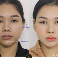 Combo Tạo hình đường viền mặt biến mặt lồi lõm thành thanh tú !