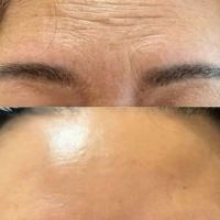 SO SÁNH CĂNG DA TRÁN VÀ CĂNG CHỈ TRÁN: PHƯƠNG PHÁP NÀO XÓA NHĂN TỐI ƯU HƠN?